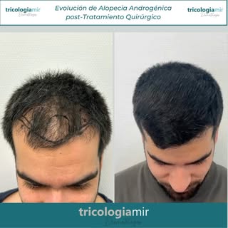 Trasplante capilar en alopecia androgénica en tercios frontal y medio! 

Gracias a nuestro paciente 