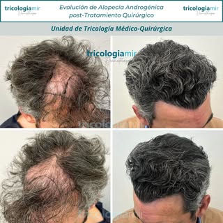 Mejoría tras trasplante capilar en #alopeciaandrogenetica que afectaba una área importante.

Gracias