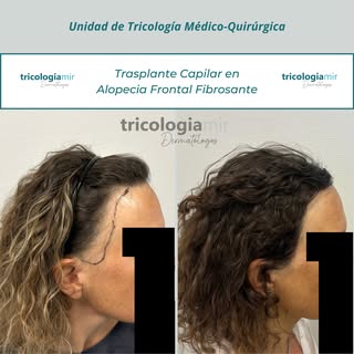 Seguimos avanzando en mujeres con alopecia frontal fibrosante! 

Las nuevas técnicas quirúrgicas en 