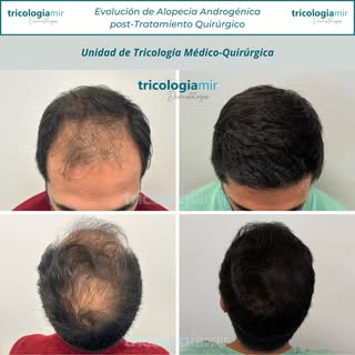Mejoría tras trasplante capilar en varón con #alopeciaandrogenetica !

#alopecia #trasplantecapilar 