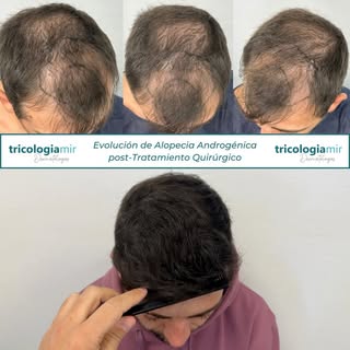 Vídeo que muestra la mejoría tras trasplante capilar en #alopeciaandrogenetica 🙂

Gracias a nuestro