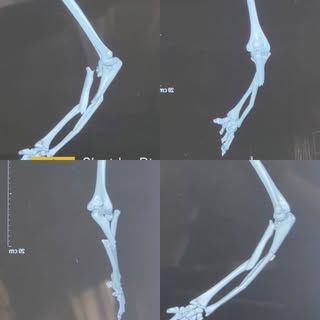 Some fracture are like puzzles where our normal teachings do not work. Choosing one approach or impl