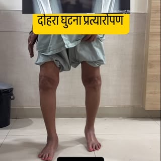 सालों पुराने गठिया से जल्द आराम घुटना प्रत्यारोपण स्वरा मिलता है । आप अगले दिन से ही चलना और चढ़ना श