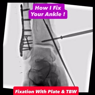Restoring stability and getting patients back on their feet! 🦶✨
A bimalleolar ankle fracture involv