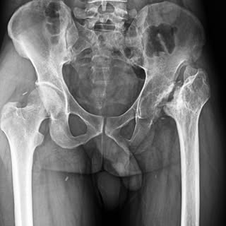 Complex Primary Total Hip Arthroplasty with Subtrochanteric Shortening Osteotomy
Managing neglected 