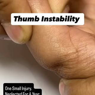 Thumb AP Instability. What do You think this is?
#thumb #injury #gorakhpur #ortho #orthopedicsurgeon