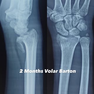 Neglected Volar Barton Fracture Fixation With Variable Angle Distal Radius Plate. #orthopaedics #fra
