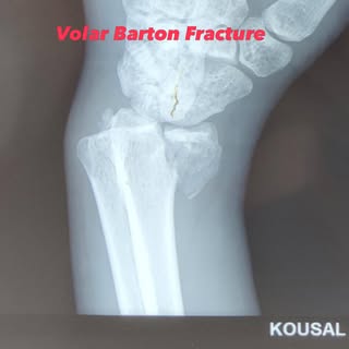 Another Day, Another Volar Barton Fracture. Managed Well with ORIF. #wrist #fracture #gorakhpur #ort