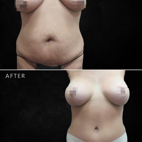 Mommy makeover (tummy tuck, breast augmentation, and liposuction of the flanks) by NYC plastic surge