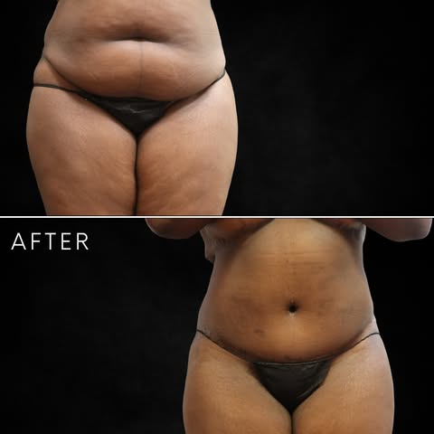 At just 4 months post-op from her tummy tuck, this patient looks amazing!

Already thrilled with her