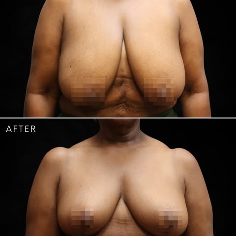 36F ➡️ 36C with a breast reduction by Dr. Elie Levine

After losing weight, this patient wanted to f