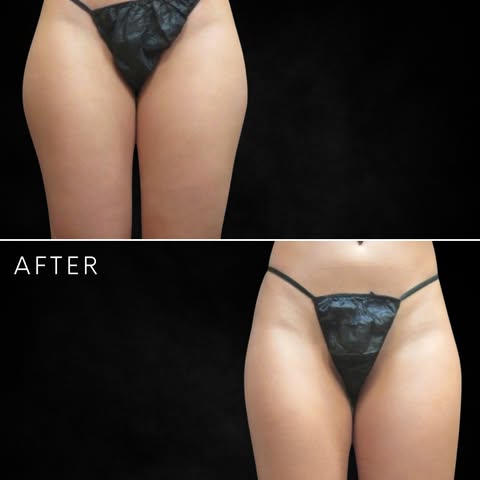 Outer thigh liposuction by Dr. Elie Levine.