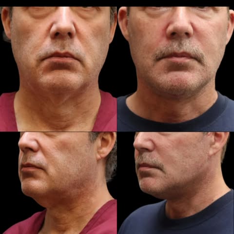 Our patient came to Dr. Elie Levine concerned with jowling, jawline laxity and loose skin on his nec