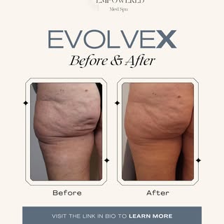 Tighten, Tone & Transform this year with EvolveX. This non-invasive procedure uses bipolar radio fre