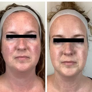 🌟Lumecca IPL Photo Facial 🌟 This patient has Rosacea and these were the beautiful results we were 