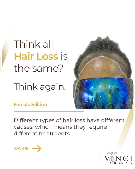Thinning at the temples? a receding hairline? Bald Patches on your scalp? Or something else entirely