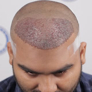 Hair transplant result #hairtransplant #hairtreatment #bald #hair