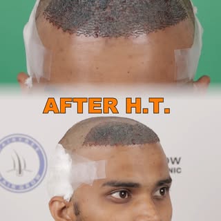 Hair Transplant result 2025 #hairtransplant #hairtreatment #hair #bald