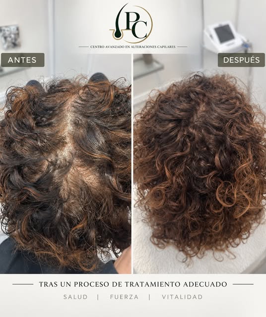 ¿NOTAS QUE TU CABELLO YA NO ES EL MISMO?

Menos densidad, más cuero cabelludo visible, pérdida de vo