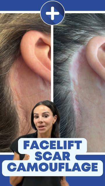 You love your facelift… but you don’t love the scars it left behind.

For many clients, those lighte