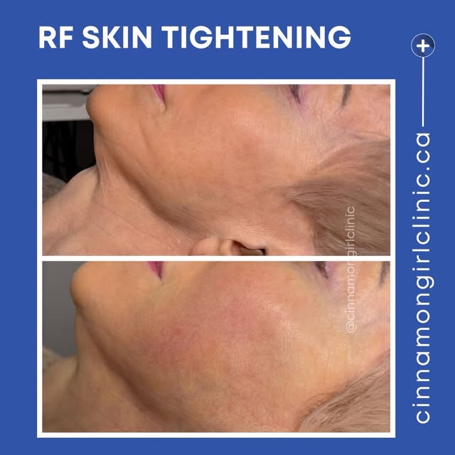 Skin tightening RF- this was after the second treatment.
#skintightening #facelifting
