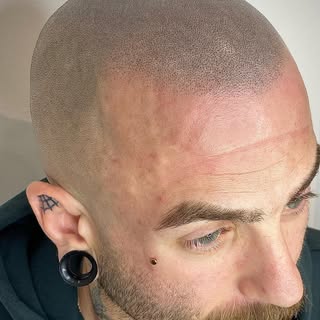 Zoom in if you want 🤷‍♂️ 
Undetectable unnoticeable and the best part about this hairline, it’s for