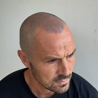 2 sessions and done ✅ super natural undetectable, top bloke now with a top hairline. He had some wor