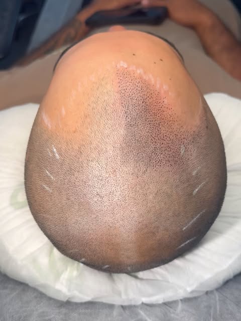 2 different bald heads 
But photo 1 is day 1
Photo 2 is 3 years down the line healed
-
Cracking a eg