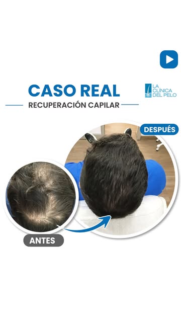 No es resignarse. Es atenderlo. 🤍

Si estás notando más caída, menos densidad o cambios en tu cabel