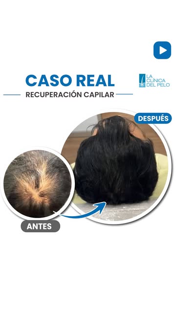 ¿Tu coronilla está perdiendo volumen? 
Este mensaje es para vos. 👇

A veces la pérdida de cabello e