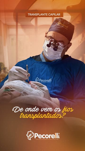 De onde vêm os fios transplantados? 👀
Do próprio paciente! Cada unidade folicular é cuidadosamente 