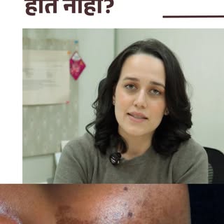 Melasma doesn’t disappear overnight — and changing creams again and again won’t solve the problem.

