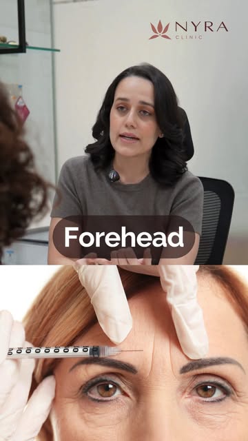 Is Botox only for the forehead? No.
Botox can be used in several areas of the face, including the fo