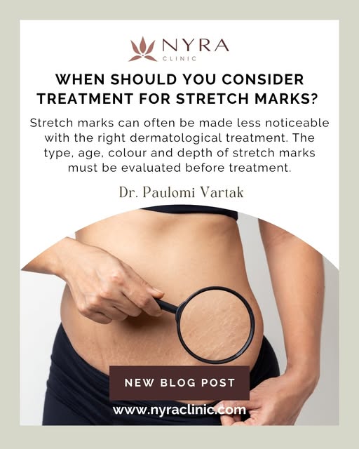 Stretch marks are extremely common and can appear during pregnancy, puberty, rapid weight gain or we