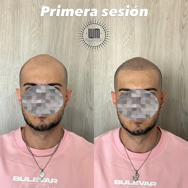 Aquí en “WM” te vas feliz desde el primer momento🦾 

Micropigmentacion 
capilar WM 🔥🔥🔥 
Los núme