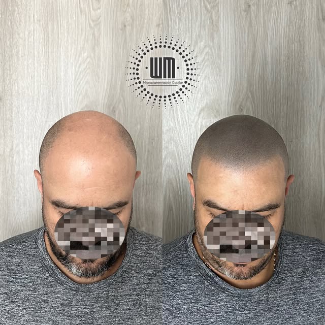 ✨Una Micropigmentación Capilar hecha para verse natural, no para que se note que está hecha.

Línea 
