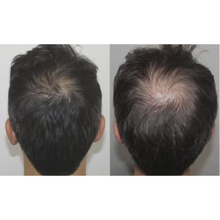 5+ years of Rogaine vs 11 Months of Stop and Regrow. You do the math. Link in Bio to book your free 