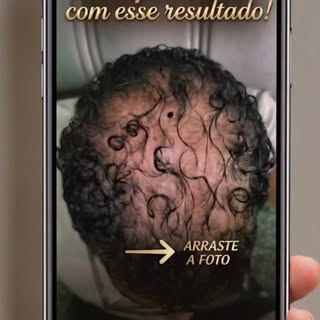 …
‼️Alopecia Androgenética é uma condição crônica, mas com o diagnóstico correto e um plano de trata