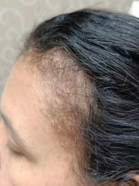 …
O que você sente quando olha para o seu cabelo hoje?

A queda capilar e as falhas no couro cabelud