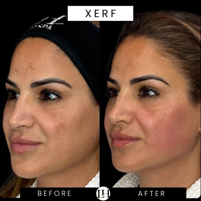 OK… I’M SCREAMING. 🤯 THESE XERF RESULTS.

Look at the definition. The firmness. The contour. The ov