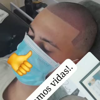Micropigmentacion capilar bogota.. línea frontal tipo jersey #peloapelo #autoestima #alopecia #calví