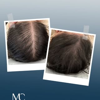Mehr Dichte, natürlichere Übergänge und ein harmonisches Gesamtbild…

Bei dieser Haartransplantation