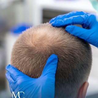 Eine Haartransplantation zielt darauf ab, licht gewordene oder kahle Bereiche mit körpereigenen Haar