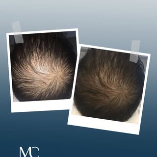 Haartransplantation für natürliche Dichte im Oberkopfbereich
Die Haartransplantation zielt darauf ab