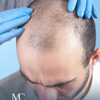 Haarausfall kann mit der Zeit auch das Selbstbewusstsein beeinflussen.
Mit einer richtigen Planung u