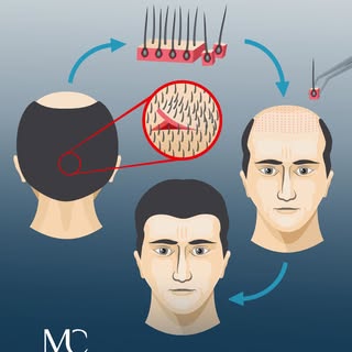 Die Haartransplantation ist ein Verfahren, das angewendet wird, um in Bereichen mit starkem Haarausf