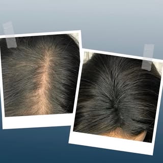 Volles Haar. Ohne Rasur. Ohne Kompromisse.

Haarausfall muss nicht bleiben.Bei Ästhemed Hair setzen 