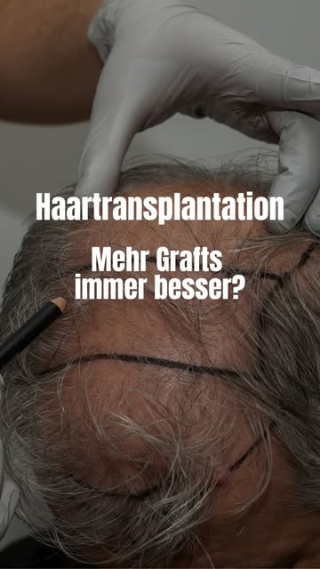 Warum sind 3.000 Graft manchmal sinnvoller als 5.000 Graft? Bei einer guten Haartransplantation komm