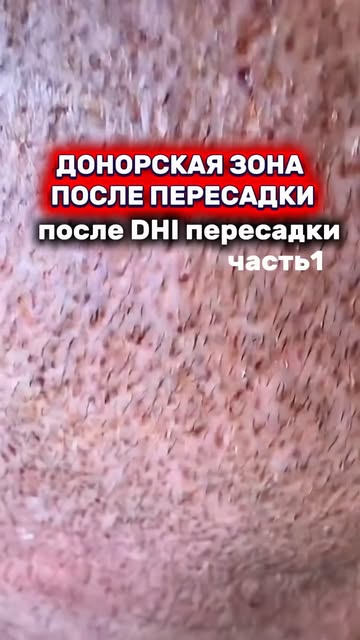 что происходит с донорской зоной после пересадки? в @ahdclinic , часть 1 ✅