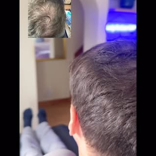 Scalp Restore By Martin #density #smp #londonsmp